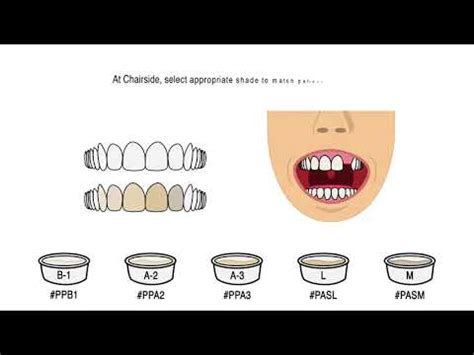 PERFECT A SMILE ALIGNER PONTIC PAINT - AB Orthodontics