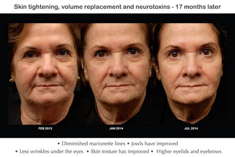 Before and After Cosmetic Dermatology - Mayoral Dermatology