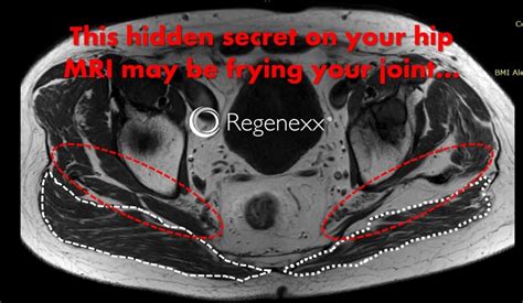 What's Hiding on Your Hip Arthritis MRI? - Regenexx®