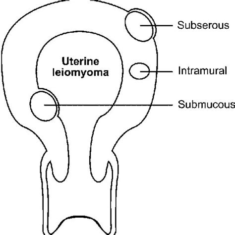 Intramurales Leiomyom Des Uterus - Captions Cute Viral