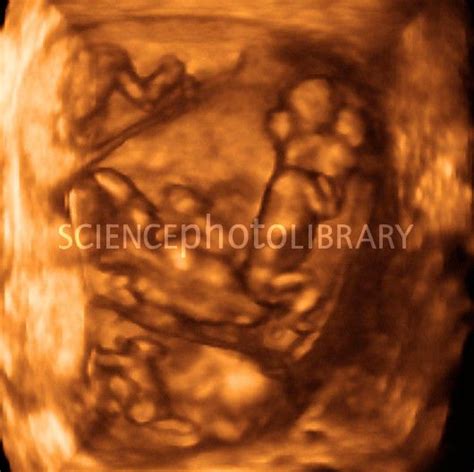 12 week quadruplets, 4-D ultrasound scan - Stock Image P680/0644 ...