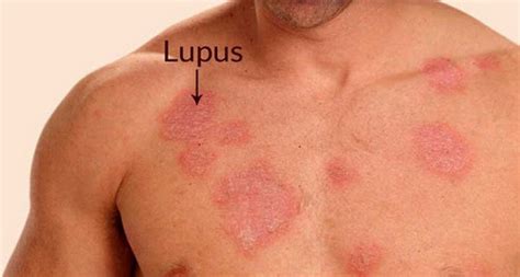 Lupus Butterfly Rash Pictures | Medical Pictures and Images - (2023 ...