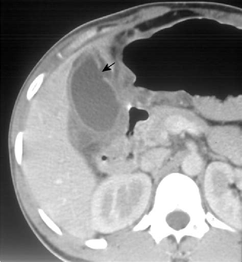 Perforation of gallbladder | Semantic Scholar