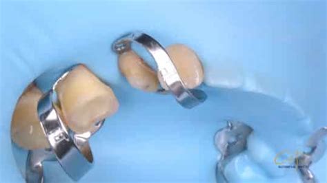 Rubber Dam Isolation Technique | Dental Guide for Clamp Selection ...