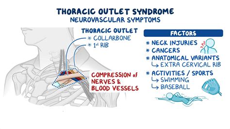 Thoracic outlet syndrome: Year of the Zebra: Video | Osmosis