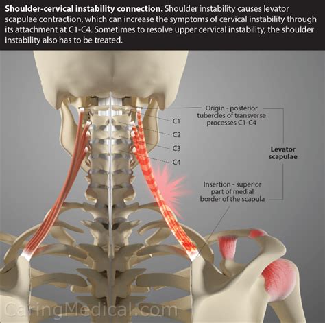 Neck And Shoulder Pain Switching Sides - mapageprek