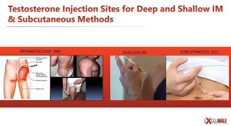 Subcutaneous Injection Sites For Injections