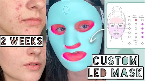 I TESTED A CUSTOM LED MASK ON MY ACNE FOR 2 WEEKS | The Ultimate Skin ...