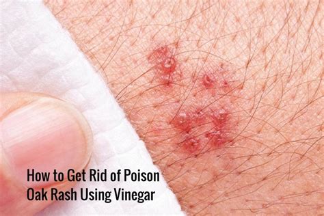 How To Get Rid Of Poison Ivy Rash Fast Bleach