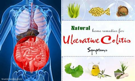 25 Home Remedies For Ulcerative Colitis Symptoms