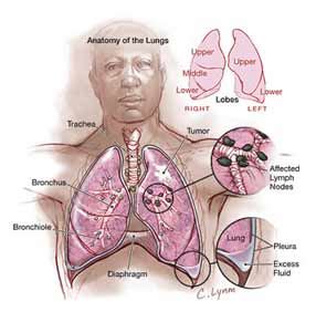 Asbestos Health Effects - Oracle Solutions