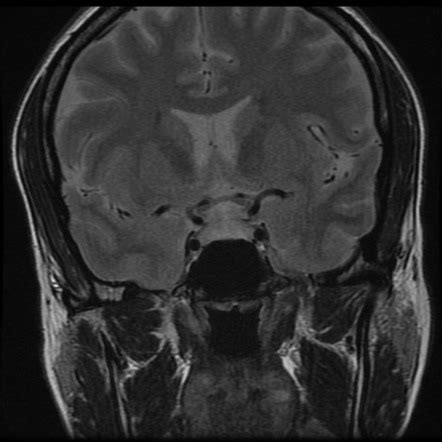 Pituitary hyperplasia | Image | Radiopaedia.org