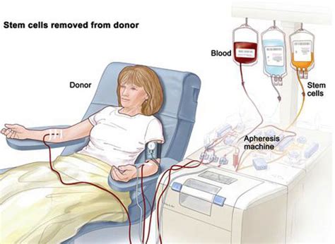 AVSF – Stem cell donation procedure