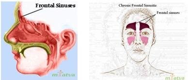 Frontal Sinusitis: Meaning, Diagnosis and Overview - mTatva Health-PIE