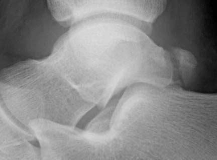 Talus Fracture (other than neck) - Trauma - Orthobullets