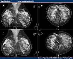 Digital Mammography in Chandigarh | ID: 7028531512