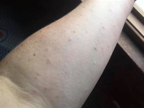 Got a Browntail Moth Rash? This Might Help