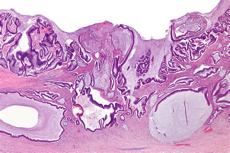 File:Colonic mucinous adenocarcinoma - very low mag.jpg - Wikimedia Commons