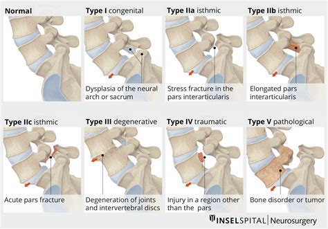 Spondylolisthesis | Neurosurgery Inselspital Bern