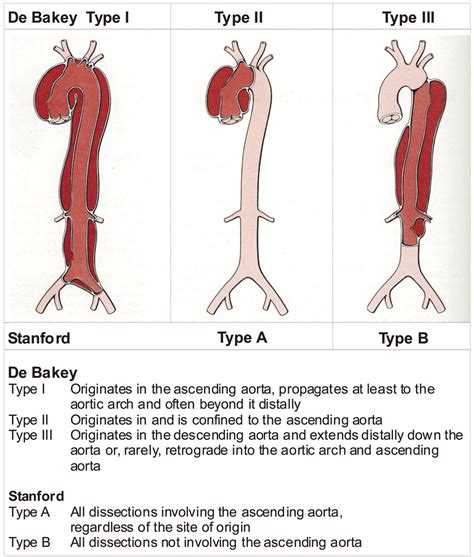 Aortic Dissection - Stepwards