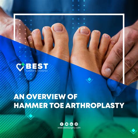 An Overview of Hammer Toe Arthroplasty | Best Surgery Center