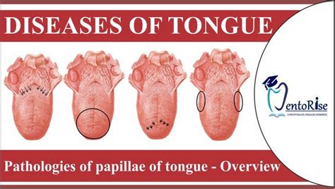 Diseases of tongue | Pathologies of papillae of tongue - Overview ...