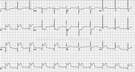 ECG Rhythms: Inferior wall STEMI with lesion in the left circumflex ...