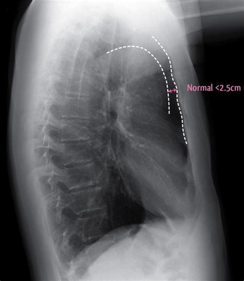 Retrosternal airspace - seen as a normal lucency between the posterior ...