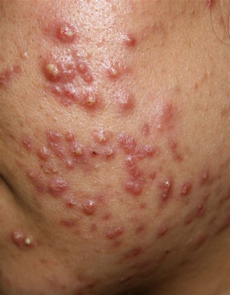 Learn about Acne Vulgaris - K B Lim Skin Clinic Pte Ltd - Dr Lim Kah Beng