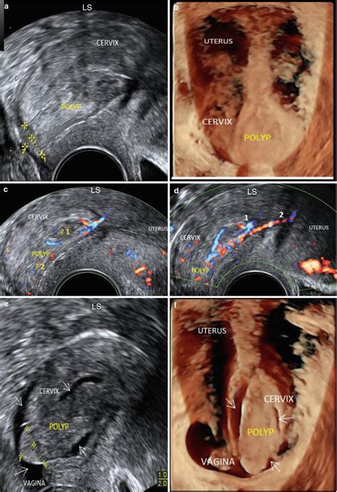 Ultrasound Evaluation of the Cervix | Obgyn Key