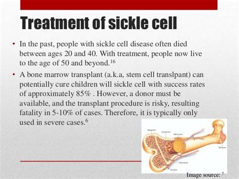 Sickle cell anemia