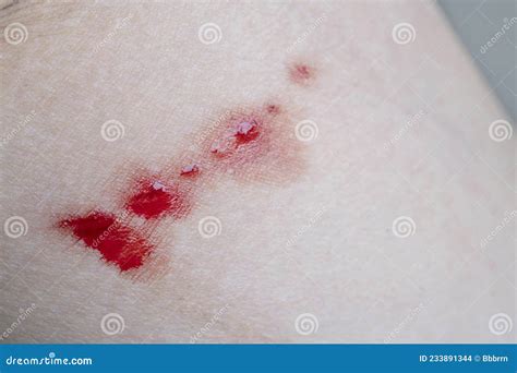 Bleeding Wound on the Skin, Caucasians Stock Photo - Image of painful ...