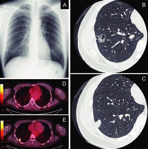 Radiographical appearance of the two lung lesions. (A) | Download ...