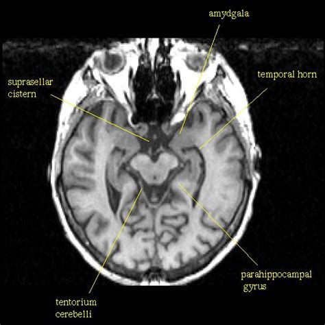 temporal_horn [Operative Neurosurgery] | Medical student motivation ...