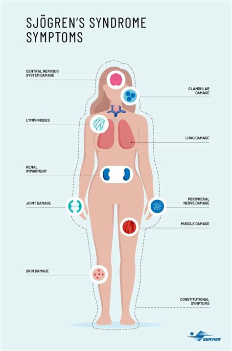 Understanding Sjogren’s Syndrome: Symptoms, Causes, and Management