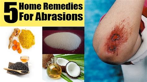 5 Home Remedies for Skin Abrasions | By Top 5. - YouTube