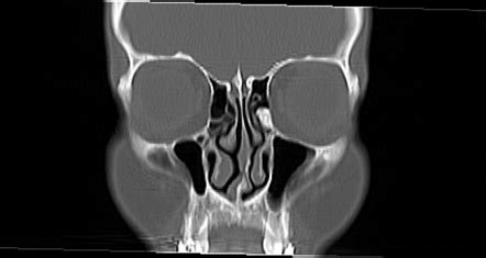 Ethmoid Air Cell Disease