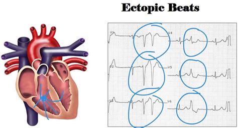 Ectopic beats causes, symptoms, diagnosis, treatment & prognosis