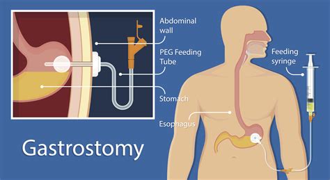 Information on Gastric Feeding Tube and Nasogastric Feeding Tube