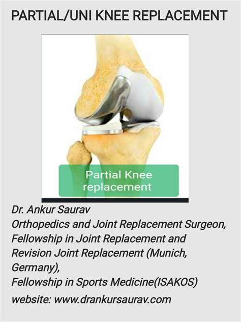 PARTIAL/UNI KNEE REPLACEMENT by ankursaurav - Issuu