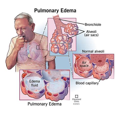 Pulmonary Edema: Causes, Symptoms, Diagnosis & Treatment