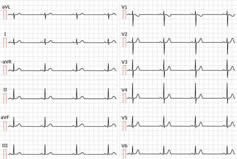 Sinus Bradycardia Vs Normal Sinus Rhythm