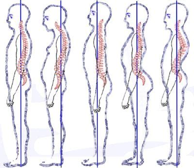 Sway Back Posture - Physiopedia