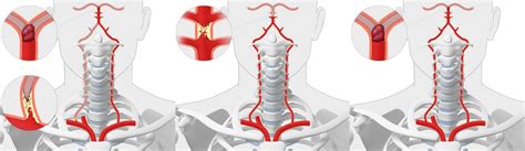 Vertebral Artery Occlusion