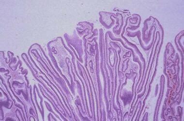 Villous Adenoma Workup: Laboratory Studies, Imaging Studies, Procedures