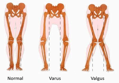 Knee joint deformities in children (leg curvature)