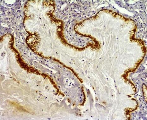 Mucinous adenocarcinoma showed strong complete membranous staining ...