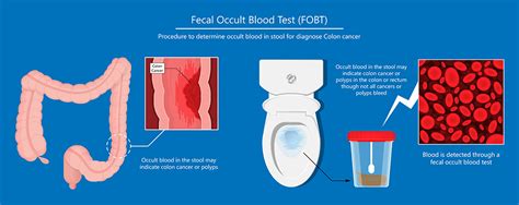 Fecal Occult Blood Test Methods, Principle, Procedure,, 47% OFF