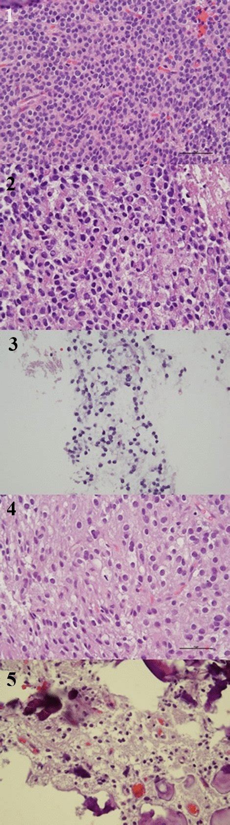 Sample from patient 1 demonstrates highly cellular proliferation of ...