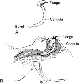 10: Nasopharyngeal Airway Insertion | Clinical Gate